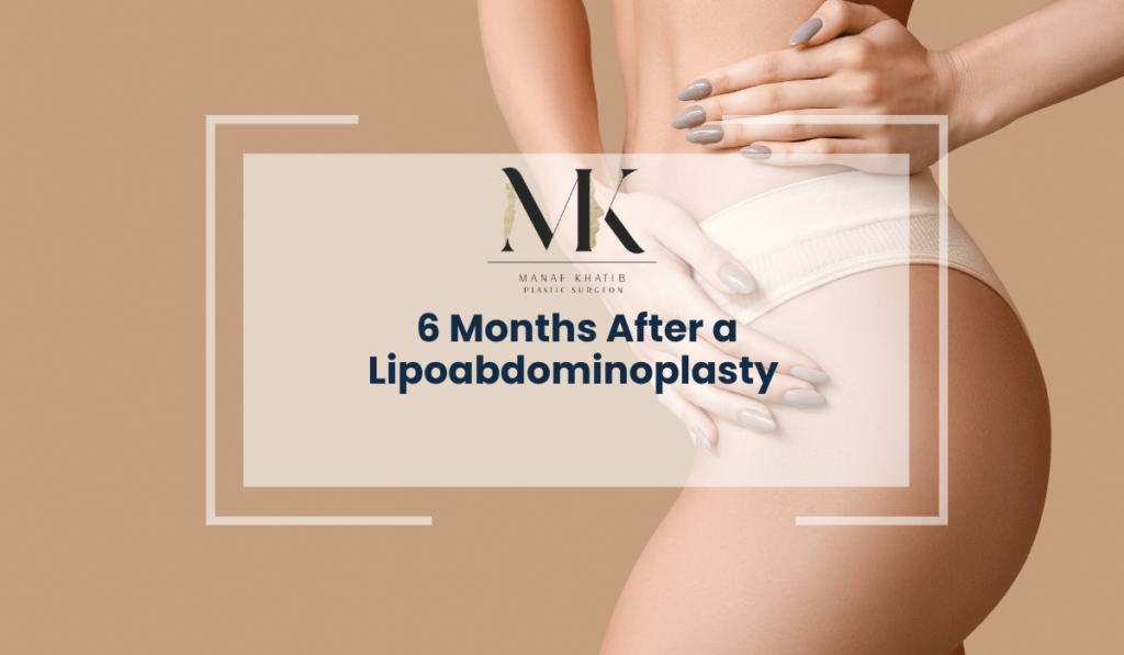 6 Months After a Lipoabdominoplasty img