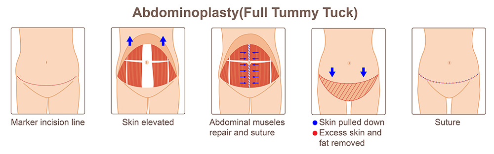 full tummy tuck