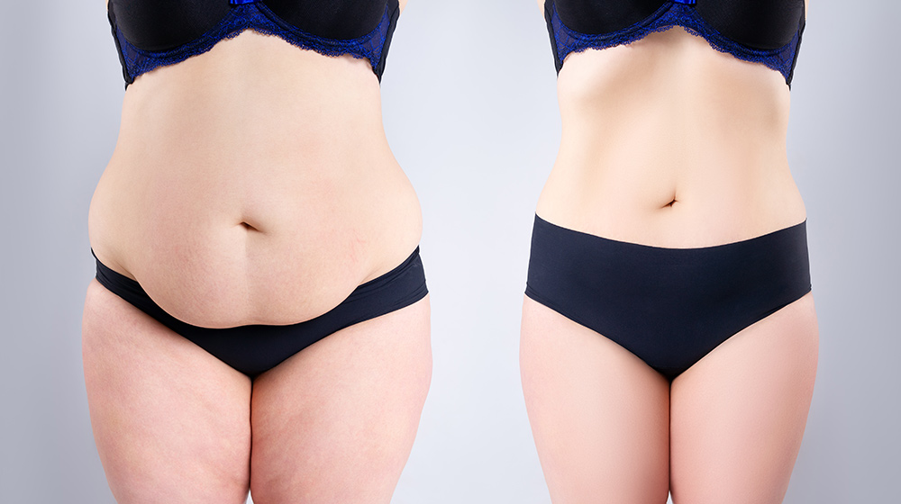 Cosmetic Surgery For Excess Skin On Arms, Stomach, Breasts | Skin Tightening | Get Rid Of Loose Skin After Weight Loss | Expert Cosmetic Surgeon London | MK Plastic Surgery Clinic