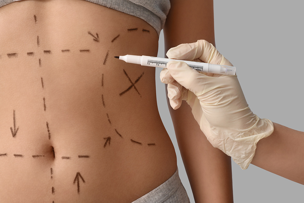 Benefits Of Extended Tummy Tuck | Abdominoplasty Results | Plastic Surgeon London & Hertfordshire | Aesthetic Surgery Specialist | MK Plastic Surgery