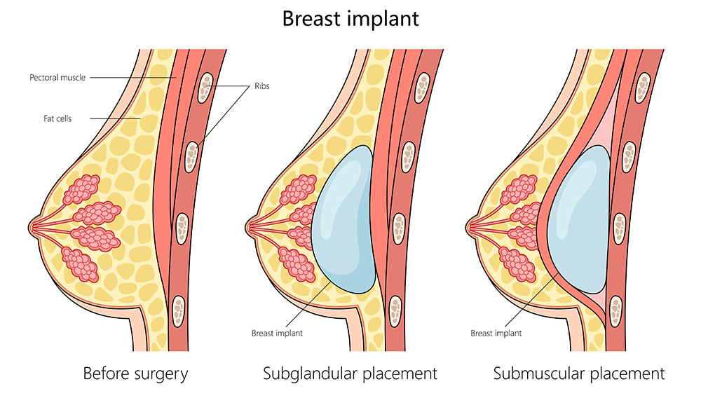 Breast Implants Under the Muscle vs Over | Over the Muscle Breast Implants | Breast Implant Over or Under Muscle