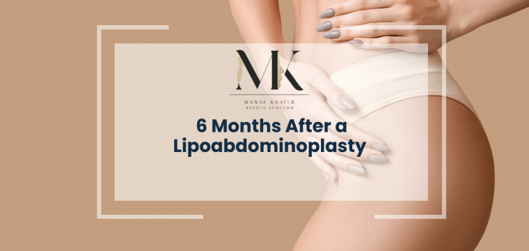 6 Months After a Lipoabdominoplasty img