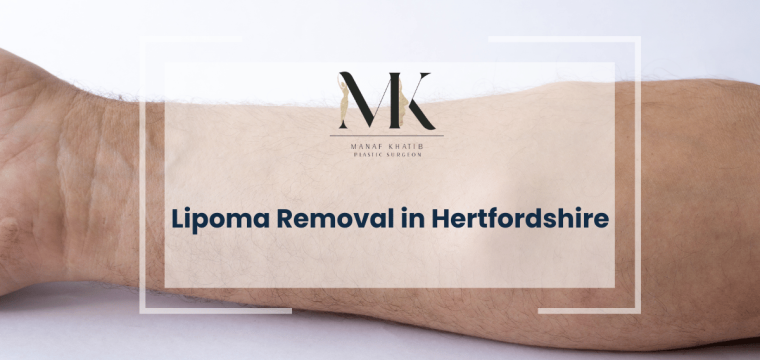 Lipoma Removal in Hertfordshire img
