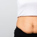 How To Remove Loose Skin After Weight Loss | Excess Stomach, Arm, or Breast Skin Removal | Cosmetic Surgeon London | MK Plastic Surgery