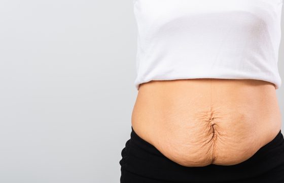 How To Remove Loose Skin After Weight Loss | Excess Stomach, Arm, or Breast Skin Removal | Cosmetic Surgeon London | MK Plastic Surgery