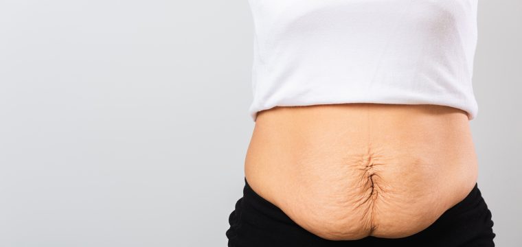 How To Remove Loose Skin After Weight Loss | Excess Stomach, Arm, or Breast Skin Removal | Cosmetic Surgeon London | MK Plastic Surgery