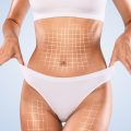 Liposuction vs Tummy Tuck | Liposuction and Tummy Tuck | Liposuction or Tummy Tuck